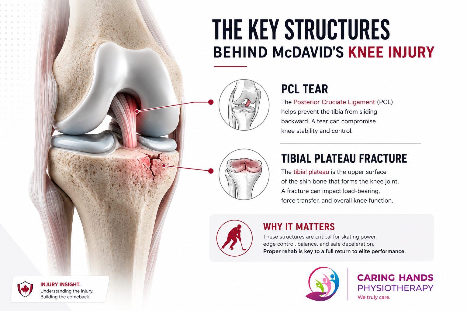 connor-mcdavid-knee-injury-anatomy-graphic Infographic explaining the PCL tear and tibial plateau fracture involved in Connor McDavid’s knee injury recovery.